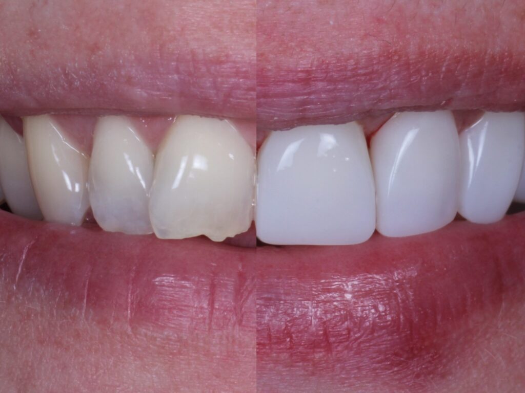 Bafore and After of smile makeover by Kevin Sacchi